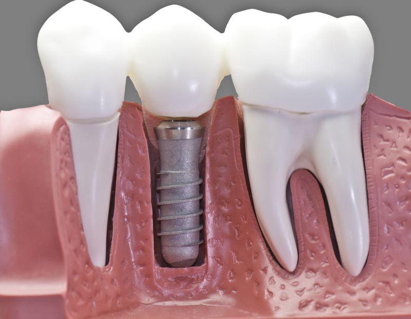 advantages-of-dental-implant