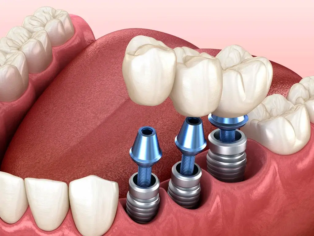 advantages of bridges & implant