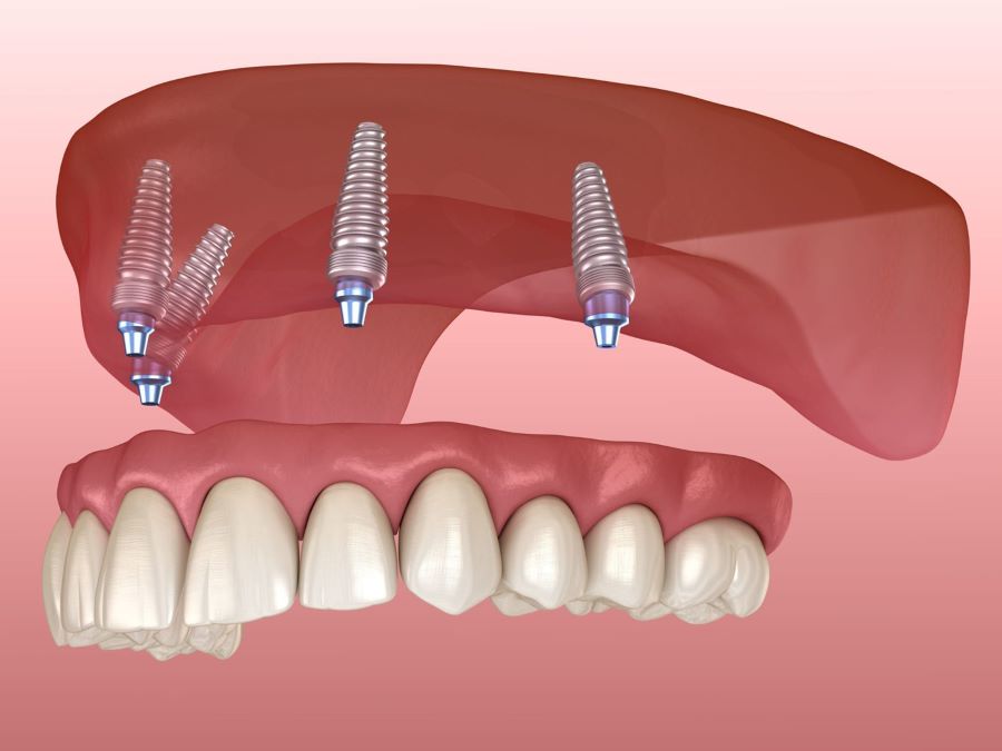 advantages-of-implant-supported