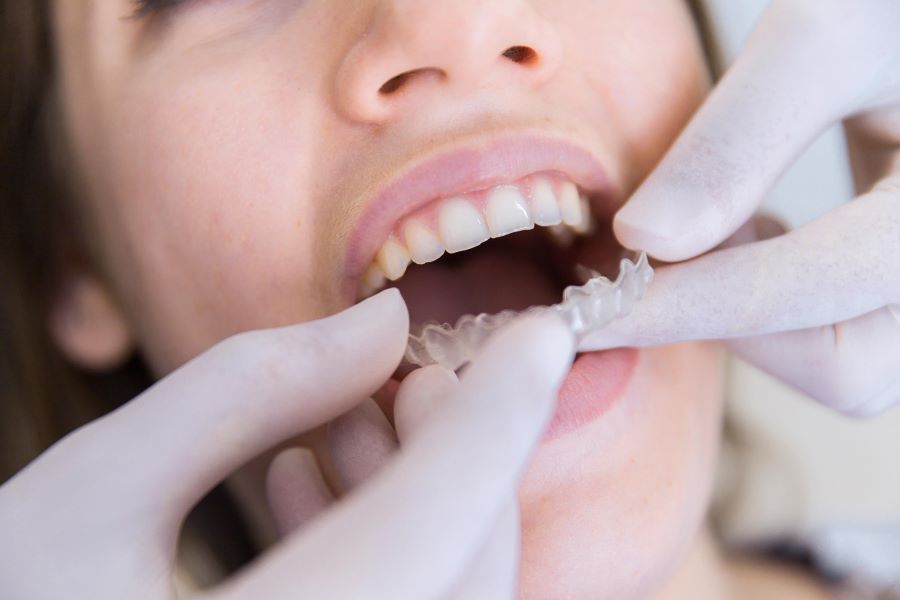 invisalign-treatment-process