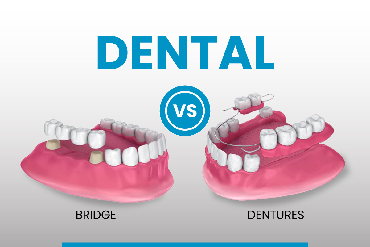 Do Dental Bridges Prove to Be More Effective Than Dentures