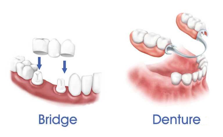 Bridges or Dentures