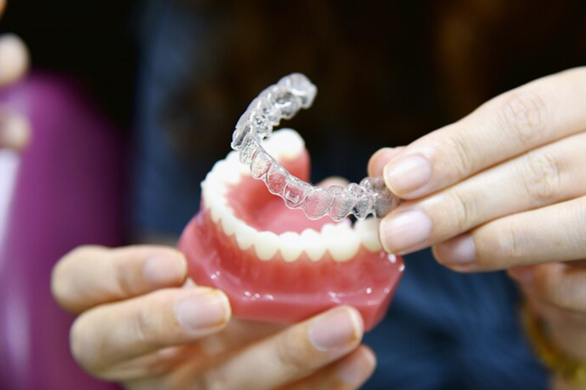 clear aligners