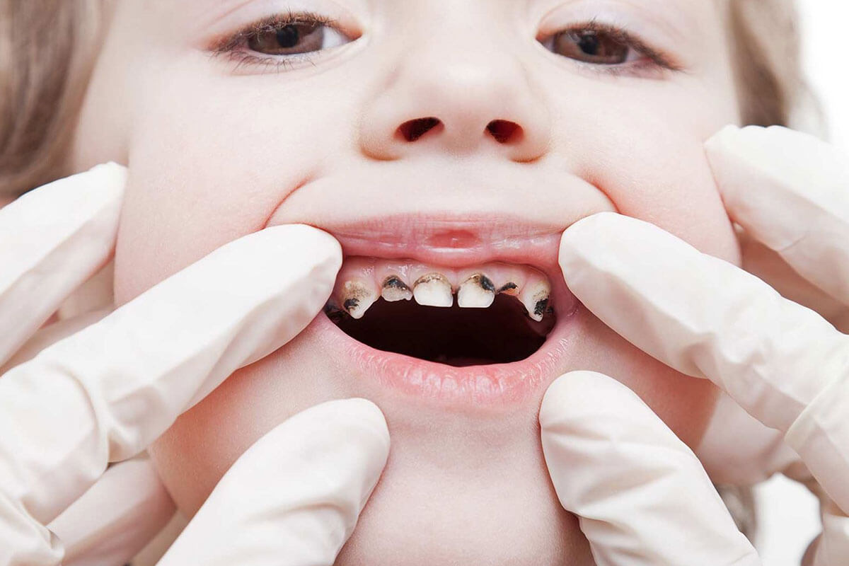 Tooth Decay: Causes, Prevention, And Symptoms