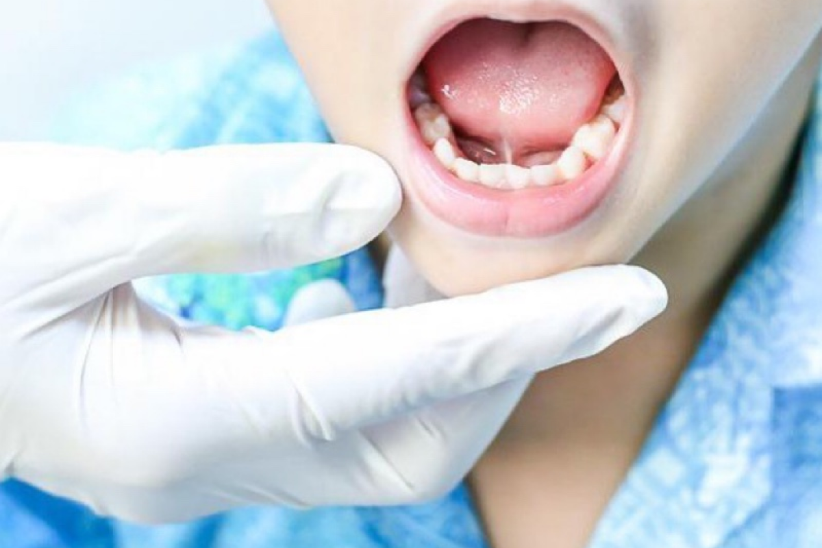 What Is A Frenectomy? Its Procedure And Why Is It Important?