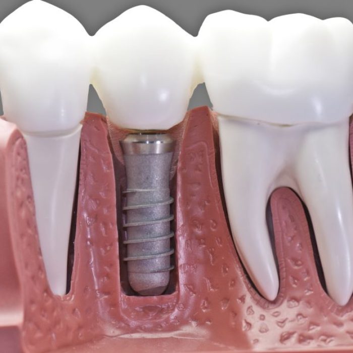 advantages-of-dental-implant