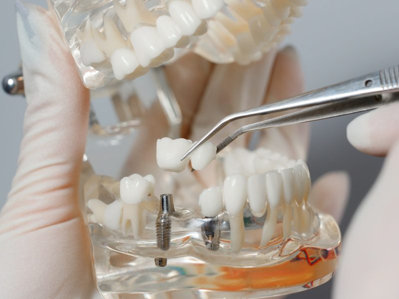 Jaw breadboard. Orthodontist teeth have been capped and stainless pin in gums.