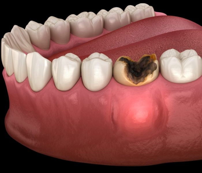 abscess-formation-min