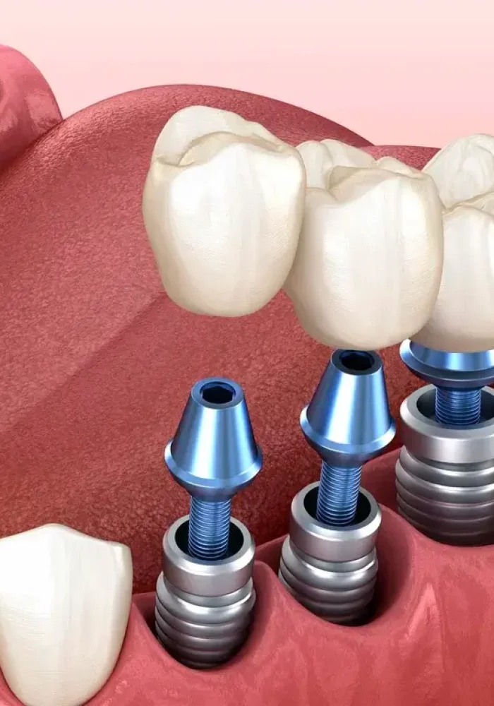 advantages of bridges & implant