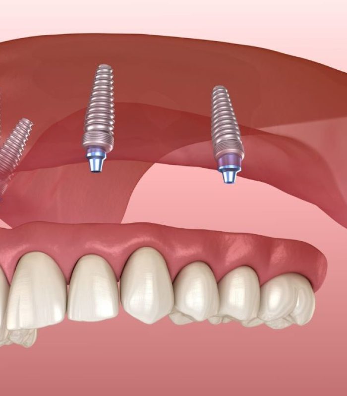 advantages-of-implant-supported