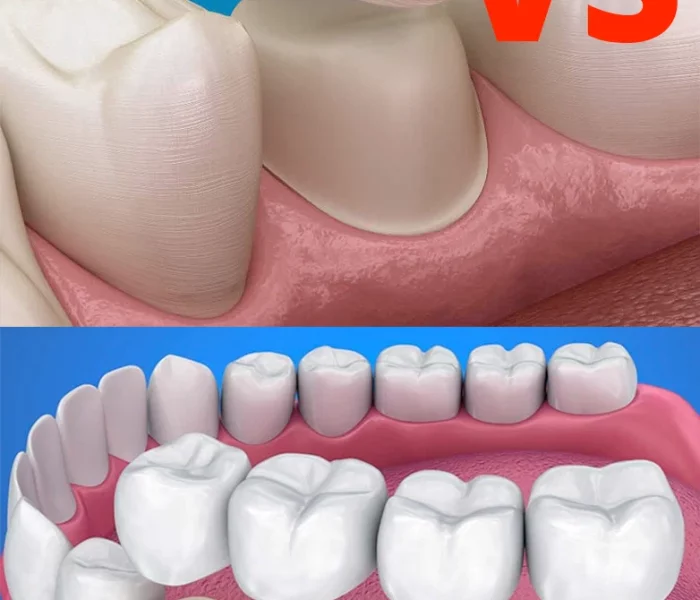 bridge-vs-partial