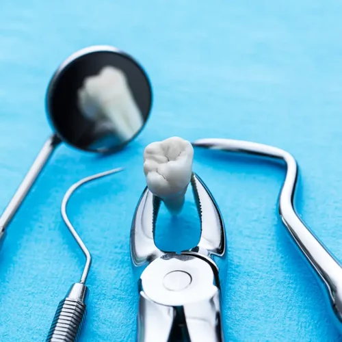 care-during-teeth-removal