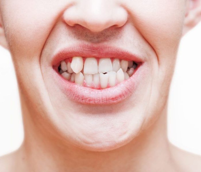 types of chipped teeth