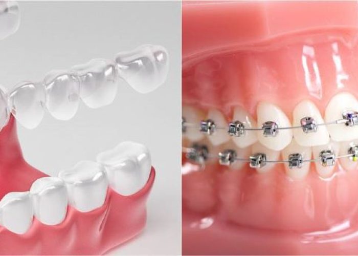 invisalgn-vs-braces