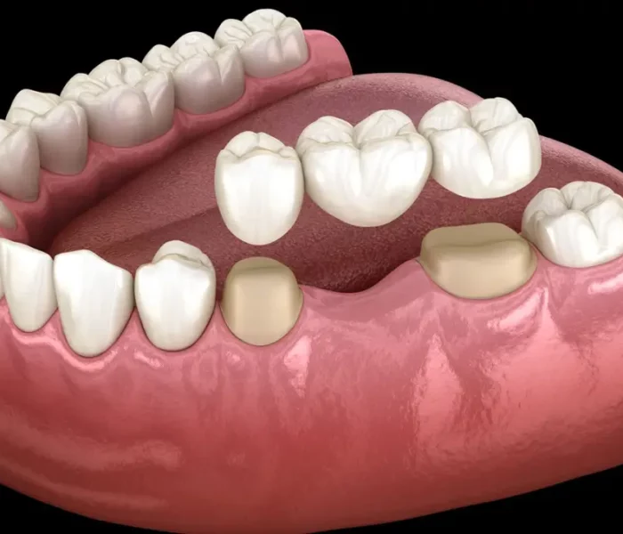 material-of-dental-bridges