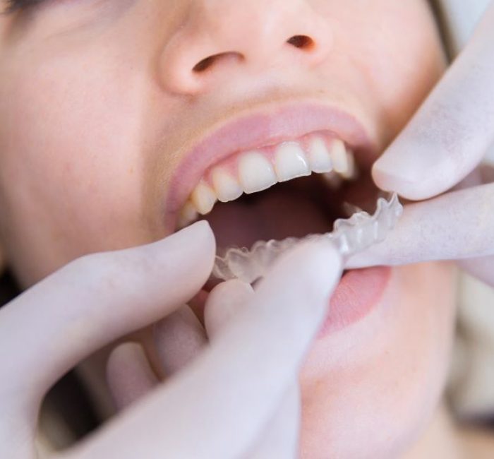 invisalign-treatment-process