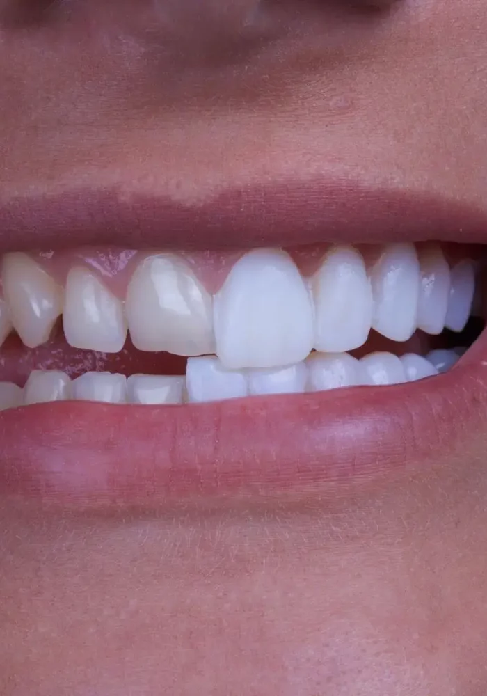 veneers